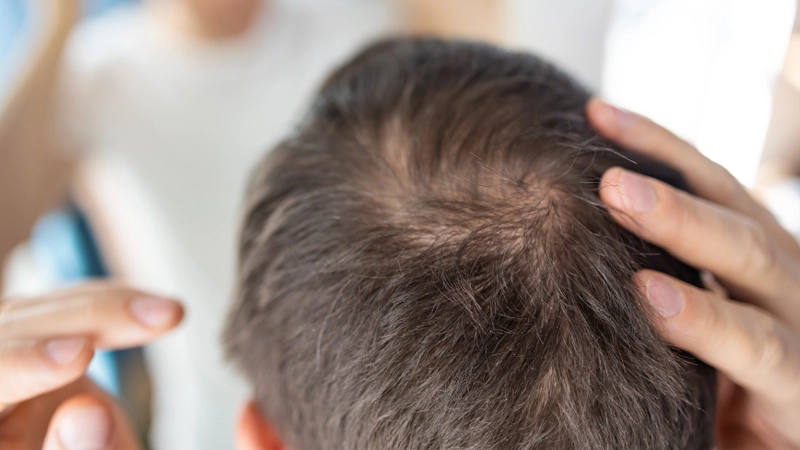 DHT بلاکر مو چیست؟ معرفی بهترین قرصها و شامپوهای ضد ریزش مو در بازار جهانی