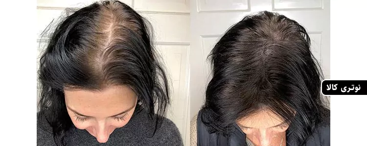 مکمل Nutrafol Women's Hair Growth Supplements از برند Nutrafol